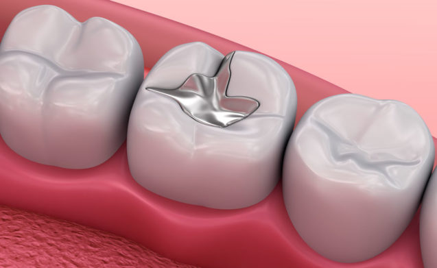 The benefits of Mercury Free Fillings